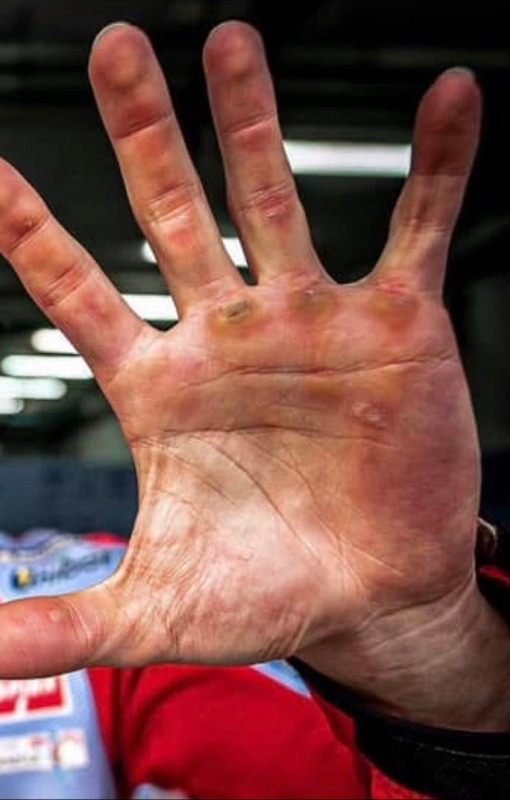geschädigte hand mit blessuren blasen schwielen angestrengte hand handschoner schutz handschutz bärenpranke gegen blasen und blessuren 